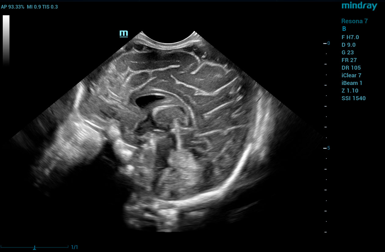 Resona 7 Image: B-mode of baby head using C11-3U