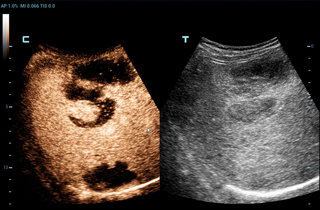 Resona 7 Image: CEUS of Liver Lymphoma