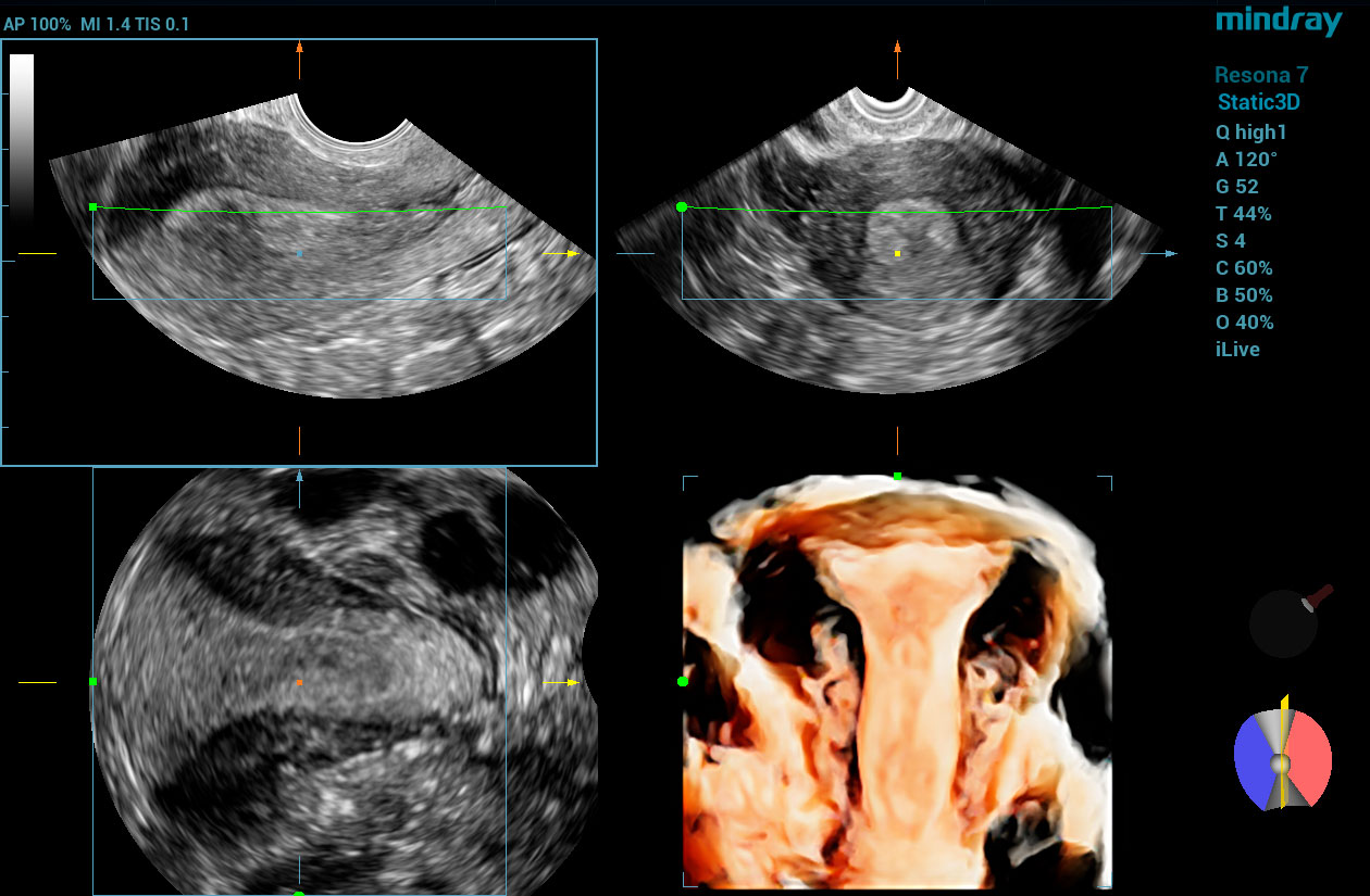 Resona 7 Image: 3D of uterus using DE10-3WU