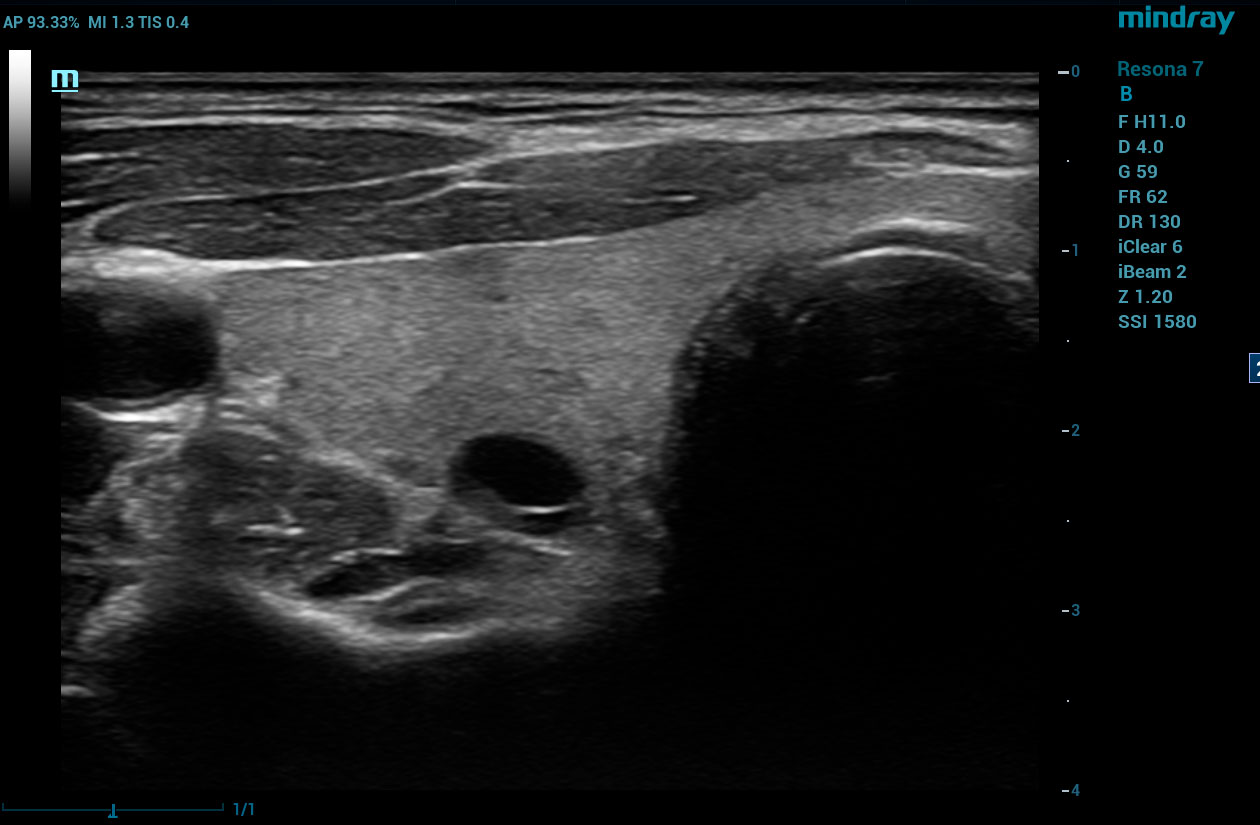 Resona 7 Image: B-mode of thyroid using L14-5W