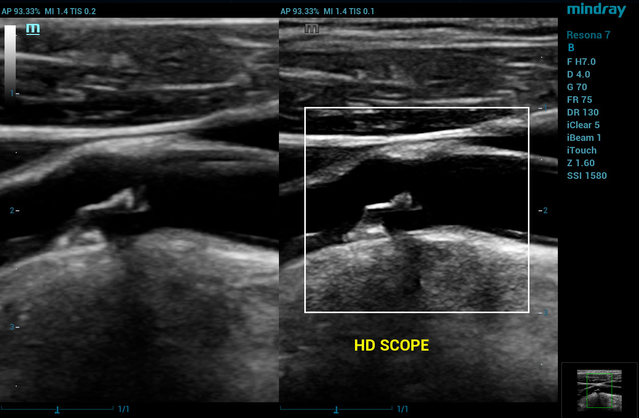Resona 7 Image: HD Scope using L9-3U