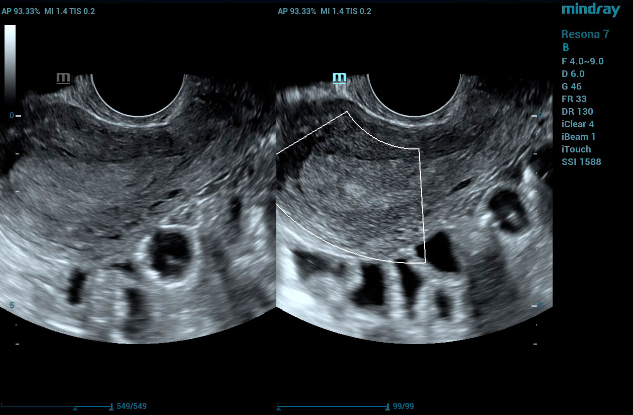 Resona 7 Image: Uterine polyp without and with HD Scope using V11-3HU