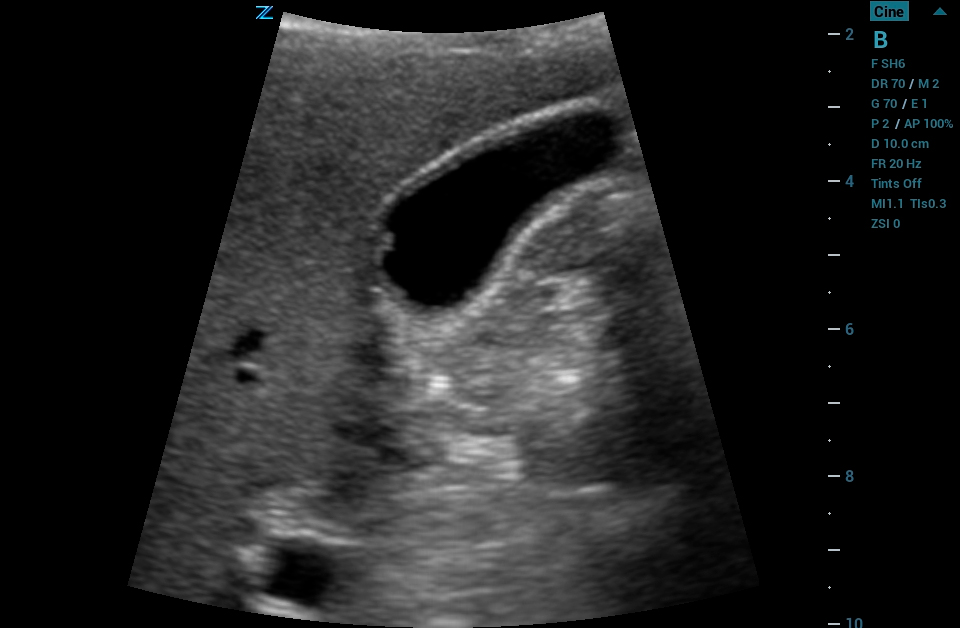 ZS3 Image: B-mode of gallbladder using C6-1