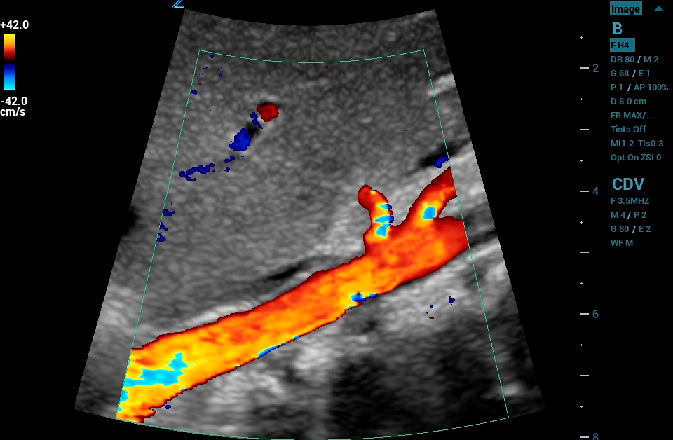 ZS3 Image: Color Doppler of aorta using C6-1