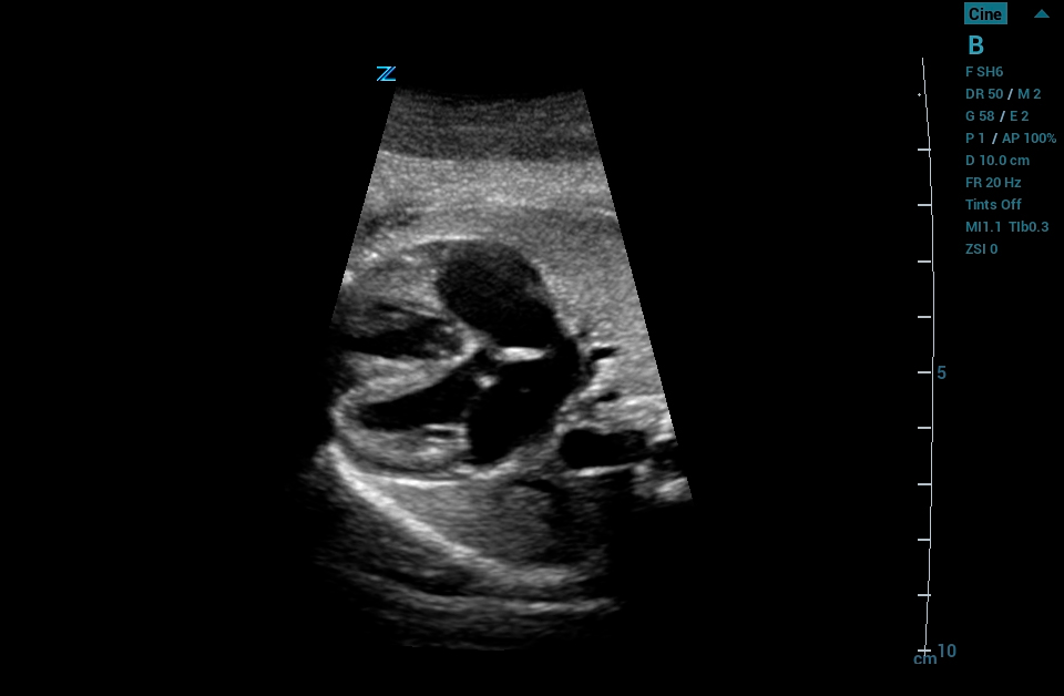 ZS3 Image: B-mode of fetal heart using C6-1
