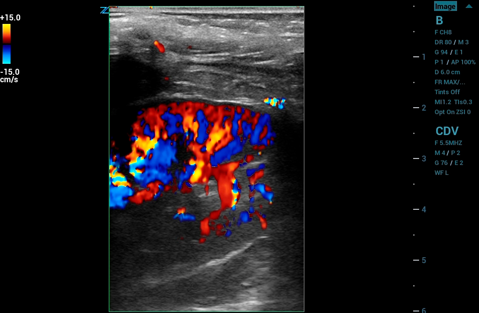ZS3 Image: Color Doppler of renal using L10-5