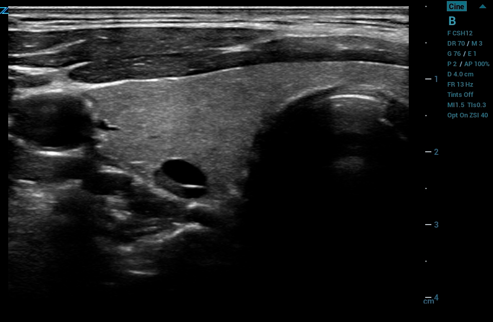 ZS3 Image: B-mode of thyroid with nodule using L14-5w
