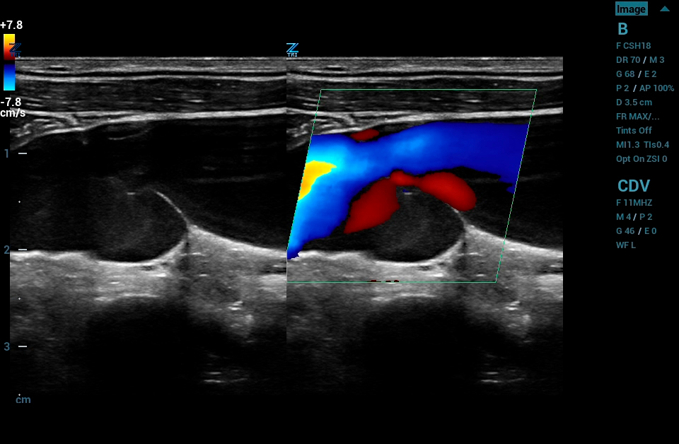 ZS3 Image: Dual image of jugular valve using L20-5