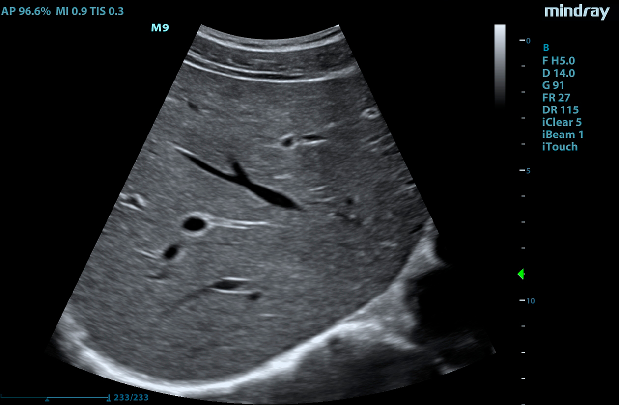 M9 Image: B-mode of liver using C5-1s