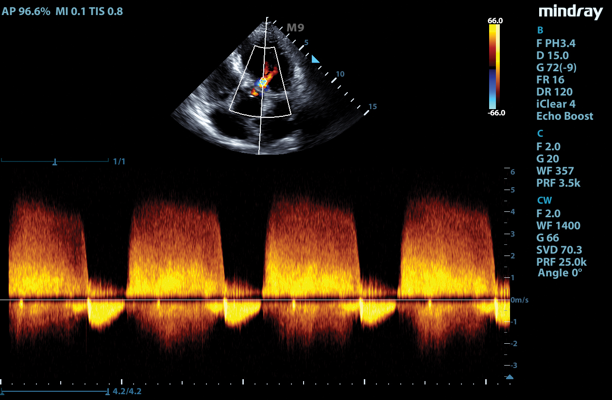 M9 Image: Continuous Wave Doppler of aortic regurgitation using SP5-1s