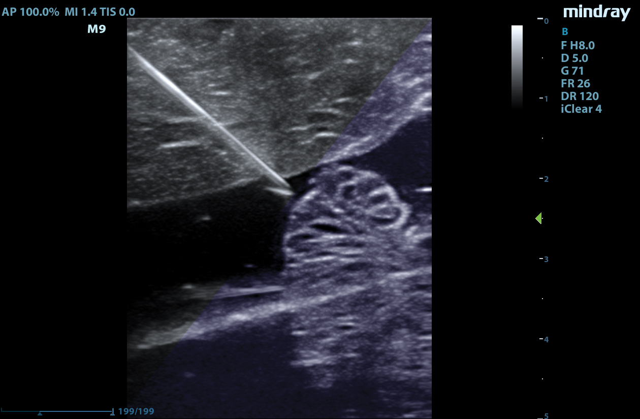 M9 Image: B-mode of iNeedle needle visualization in thyroid using L12-4s