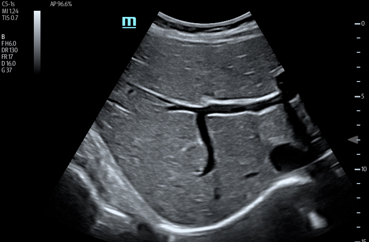 TE7 Image: B-mode of liver using C5-1s
