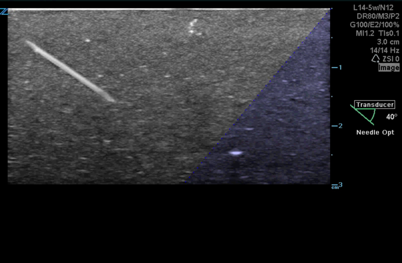 Z.One PRO image: iNeedle needle visualization in phantom using L14-5w