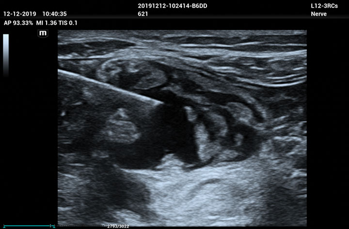 ME8 Image: brachial plexus