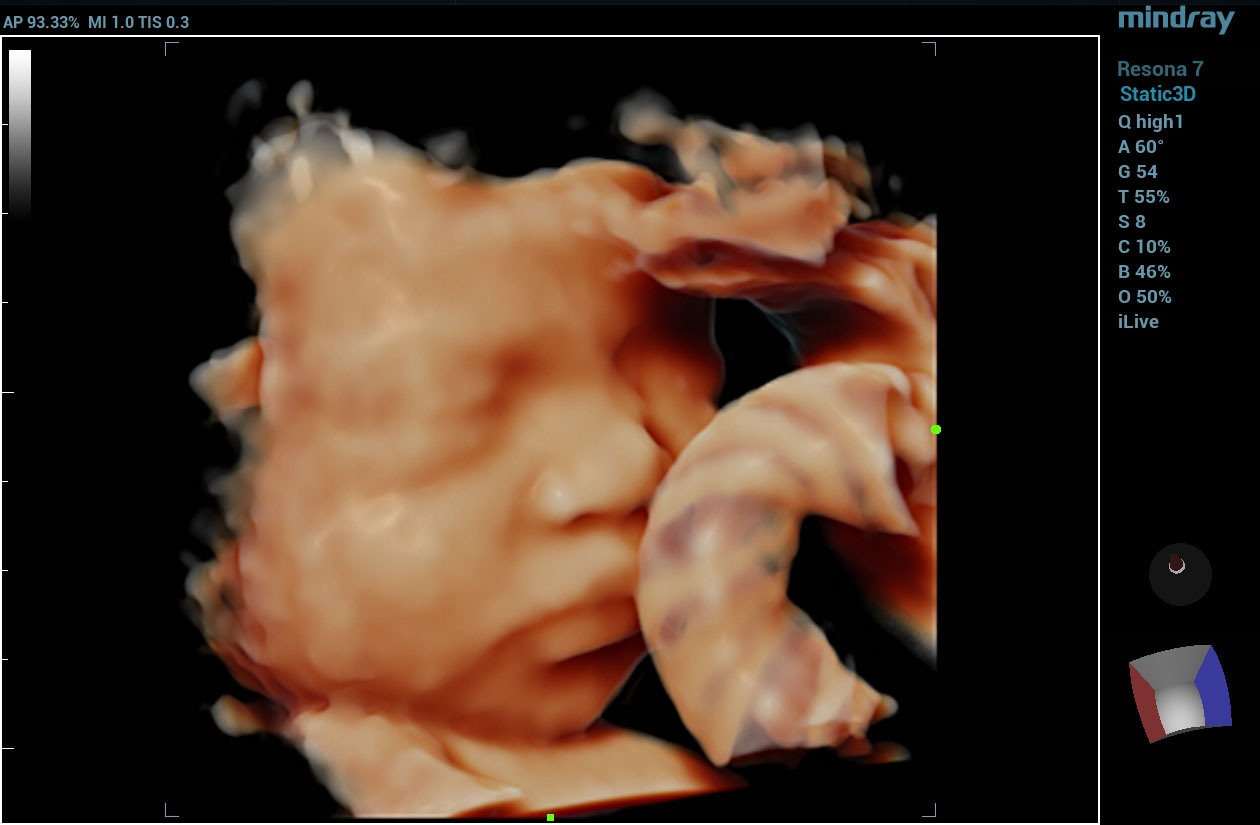 Resona 7 Image: 4D fetal face using D8-4U