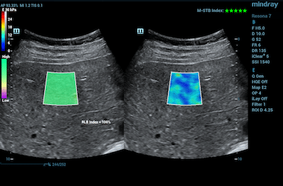 transient elastography ultrasound